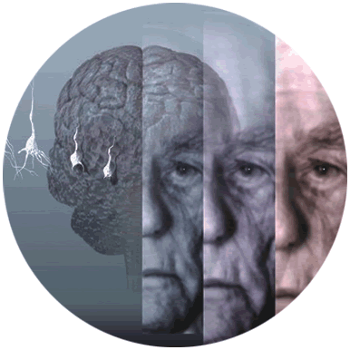 alzheimer.gif