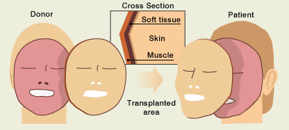 _42237830_face_transplant_whole_416_1.gif