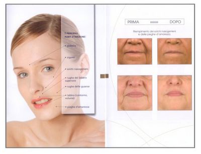 prima_dopo_fillers.jpg