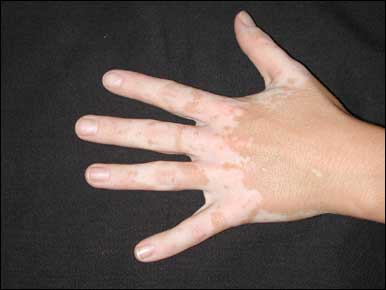 vitiligine.jpg