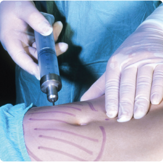 liposuction_photorsrchrs.jpg