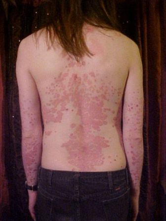 psoriasi.jpg