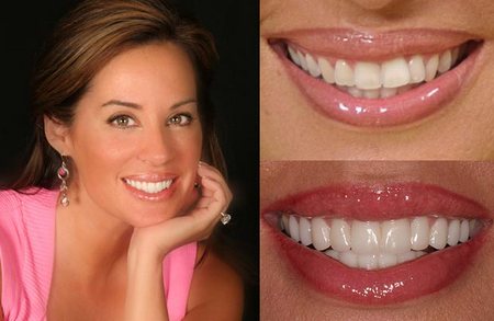 sbiancamento-dentale.jpg