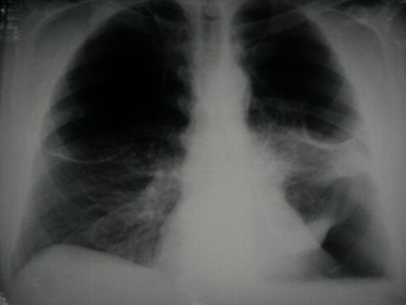enfisema