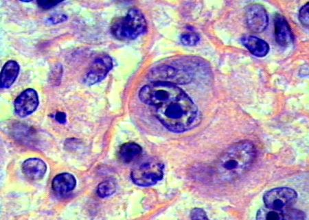 linfoma-di-hodgkin
