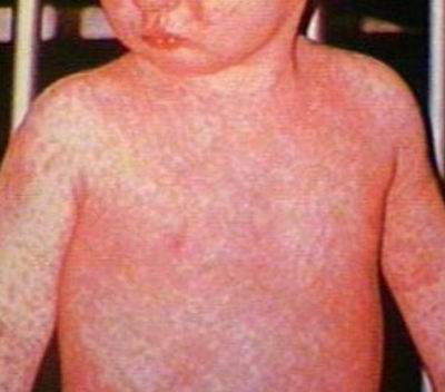 morbillo1