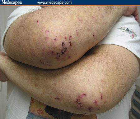 dermatite-erpetiforme1