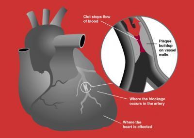ossicolesterolo rischi cuore