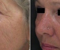 prima e dopo con microneedling prima e dopo con microneedling