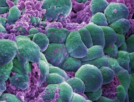 cancro-nelle-cellule cancro-nelle-cellule