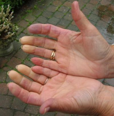 mani fredde sclerodermia mani fredde sclerodermia
