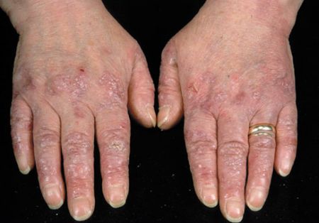 epidermiolisi bollosa