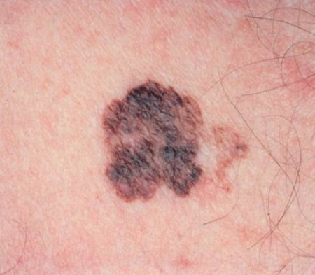 melanoma (450 x 393)