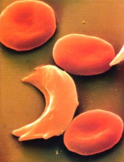 Anemia falciforme | MedicinaLive