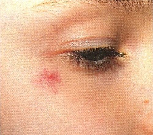 Angioma Stellato Medicinalive