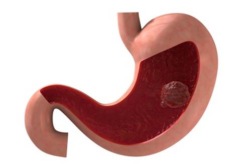 tumore colon