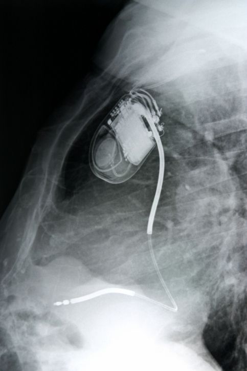radiografia di un pacemaker