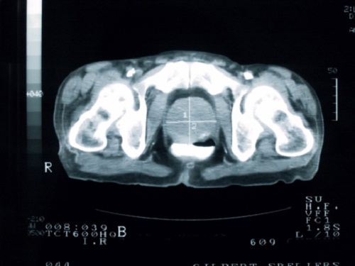 tumore prostata inefficace intervento