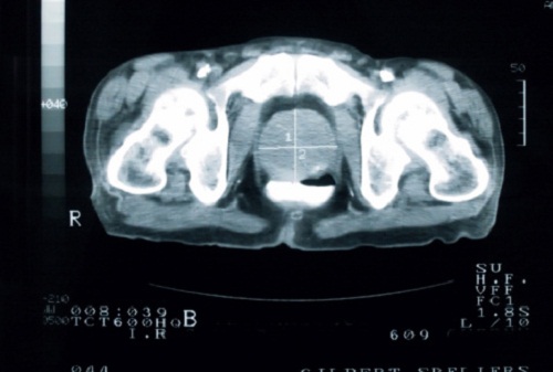 cancro prostata attenzione fettina padella