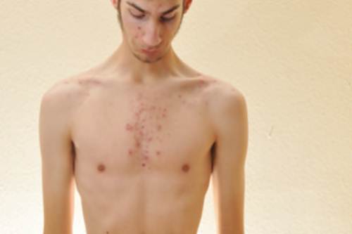 Anoressia nervosa cause sintomi testimonianze foto