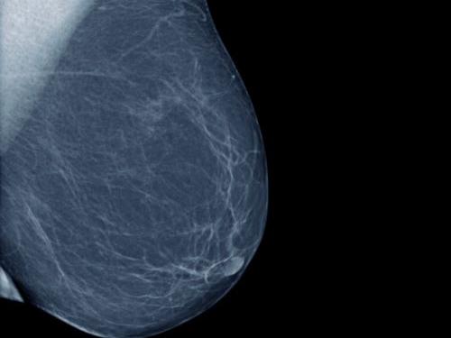 mammografia o ecografia seno diagnosi tumore