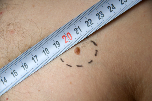 Melanoma sintomi foto cura tumore maligno