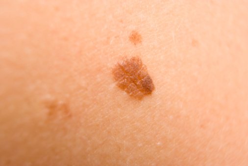 Melanoma sintomi foto cura tumore maligno