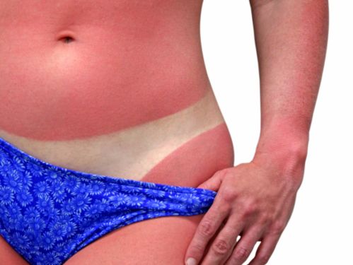 Melanoma sintomi foto cura tumore maligno