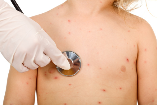 Morbillo sintomi contagio durata vaccino foto