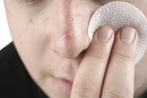 Acne giovanile cistica tardiva cause cure rimedi