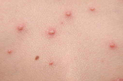 varicella adulti gravidanza neonati foto