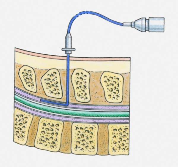 epidurale partorire