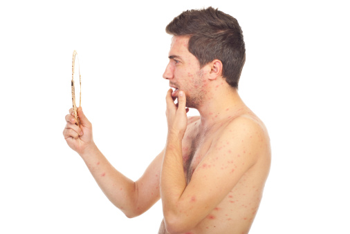 varicella adulti gravidanza neonati foto