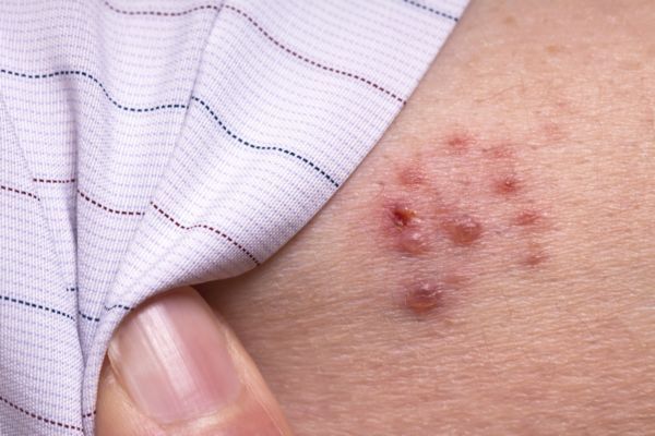 herpes zoster fuoco di sant'antonio foto