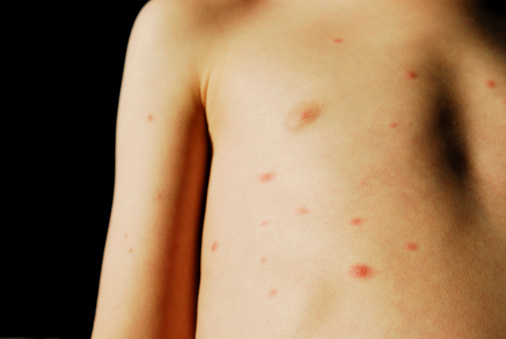 varicella adulti gravidanza neonati foto