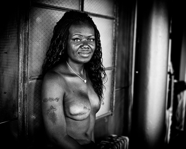 Donne operate seno: foto The Scar Project