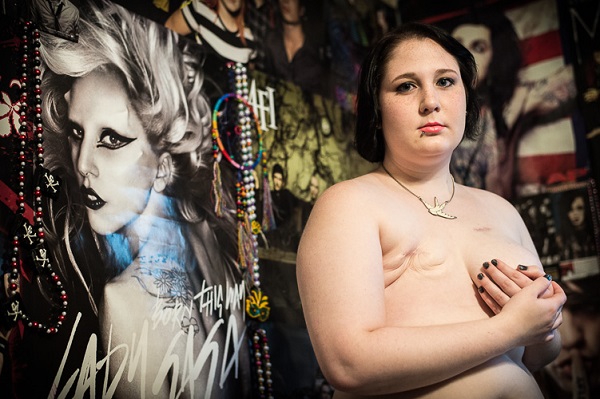Donne operate seno: foto The Scar Project
