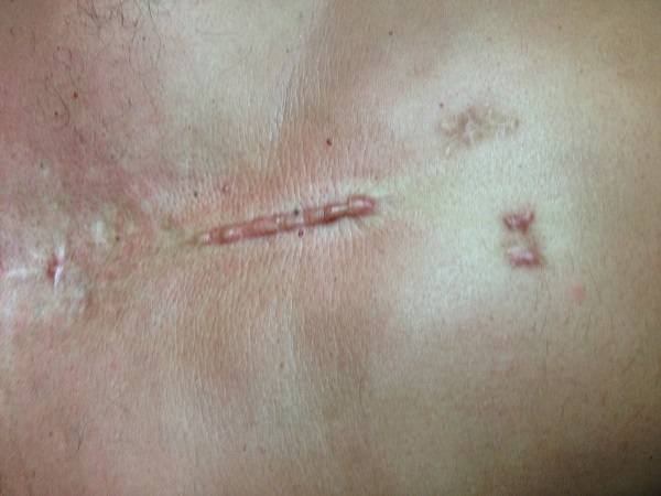 cicatrice cheloide laser funziona foto