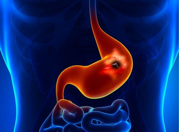 tumore stomaco inoperabile metastasi