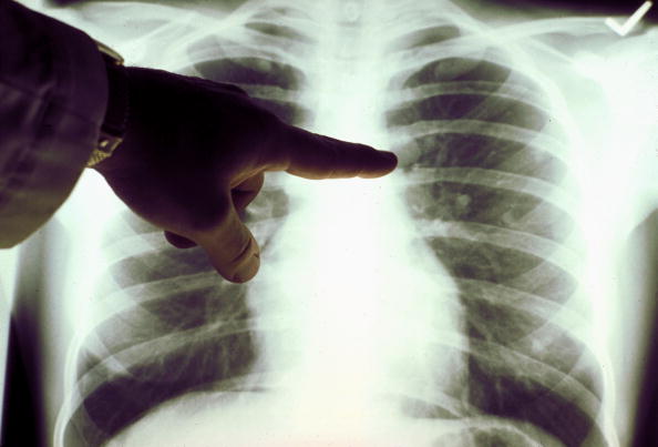 Iperaccumulo di tracciante nella PET, che significa? 