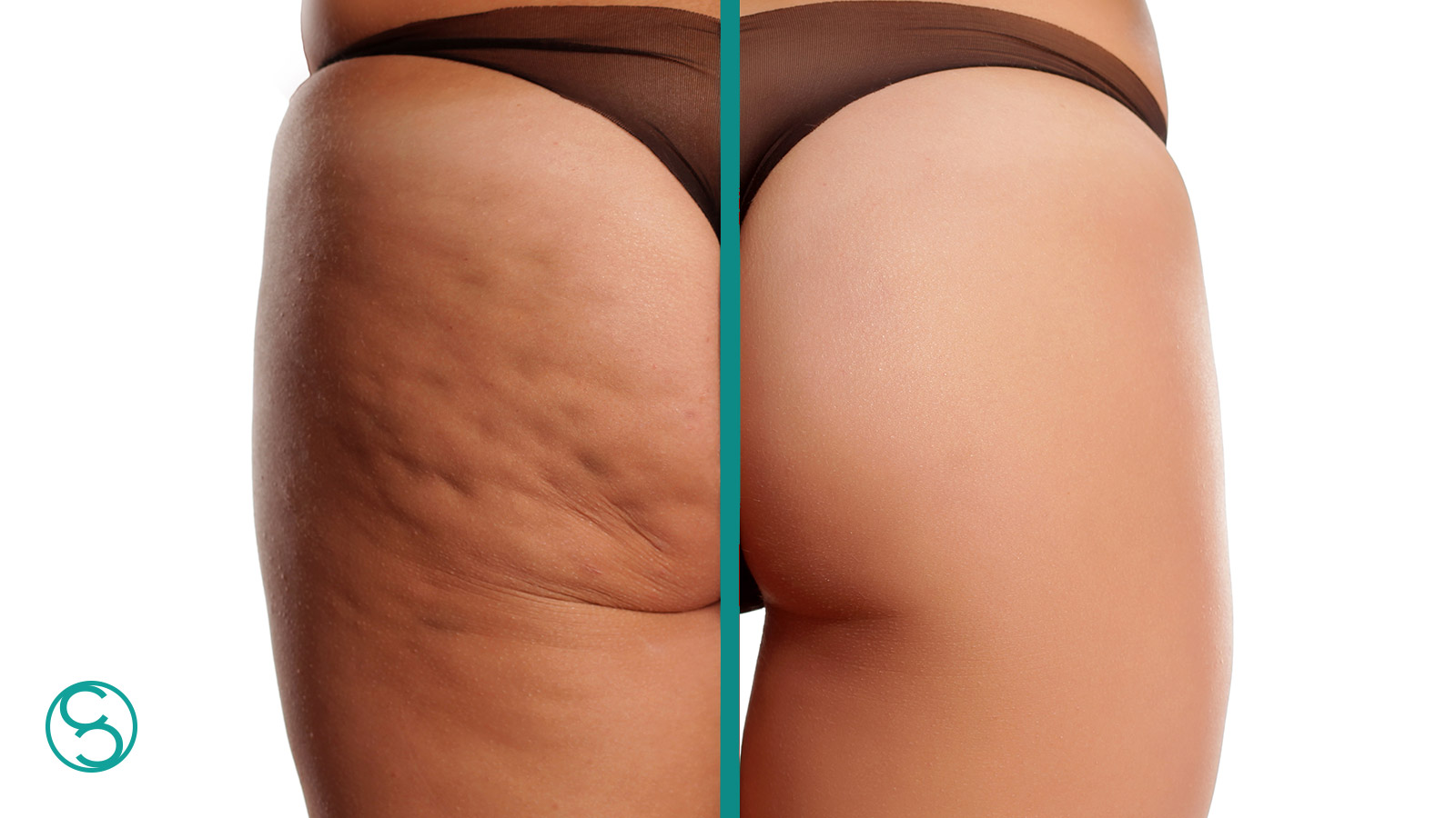 Cellulite